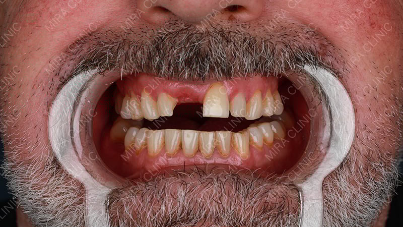 Graham’s Dental Problem – Tooth Loss